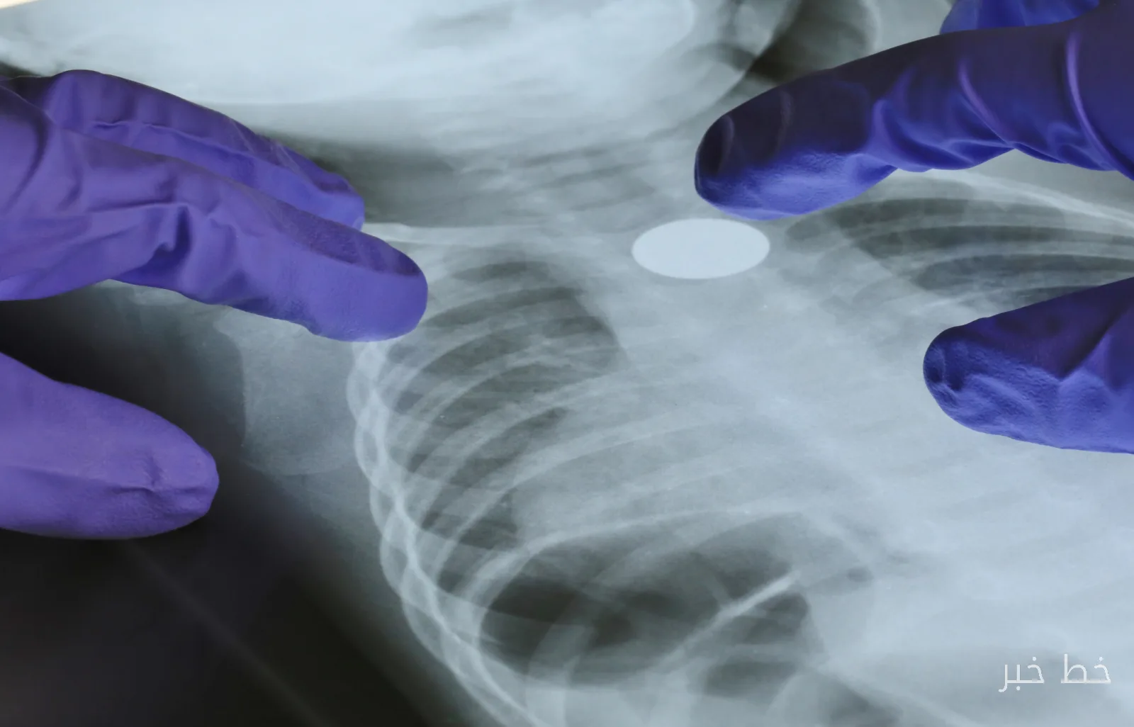 New research shows that a genetic mutation may explain lung cancer in non-smokers